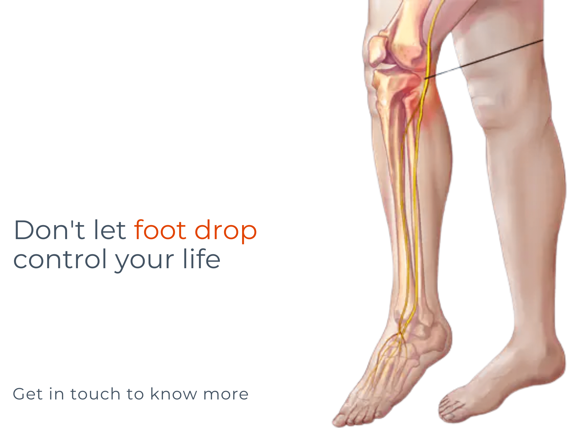 Drop Foot Medical Term