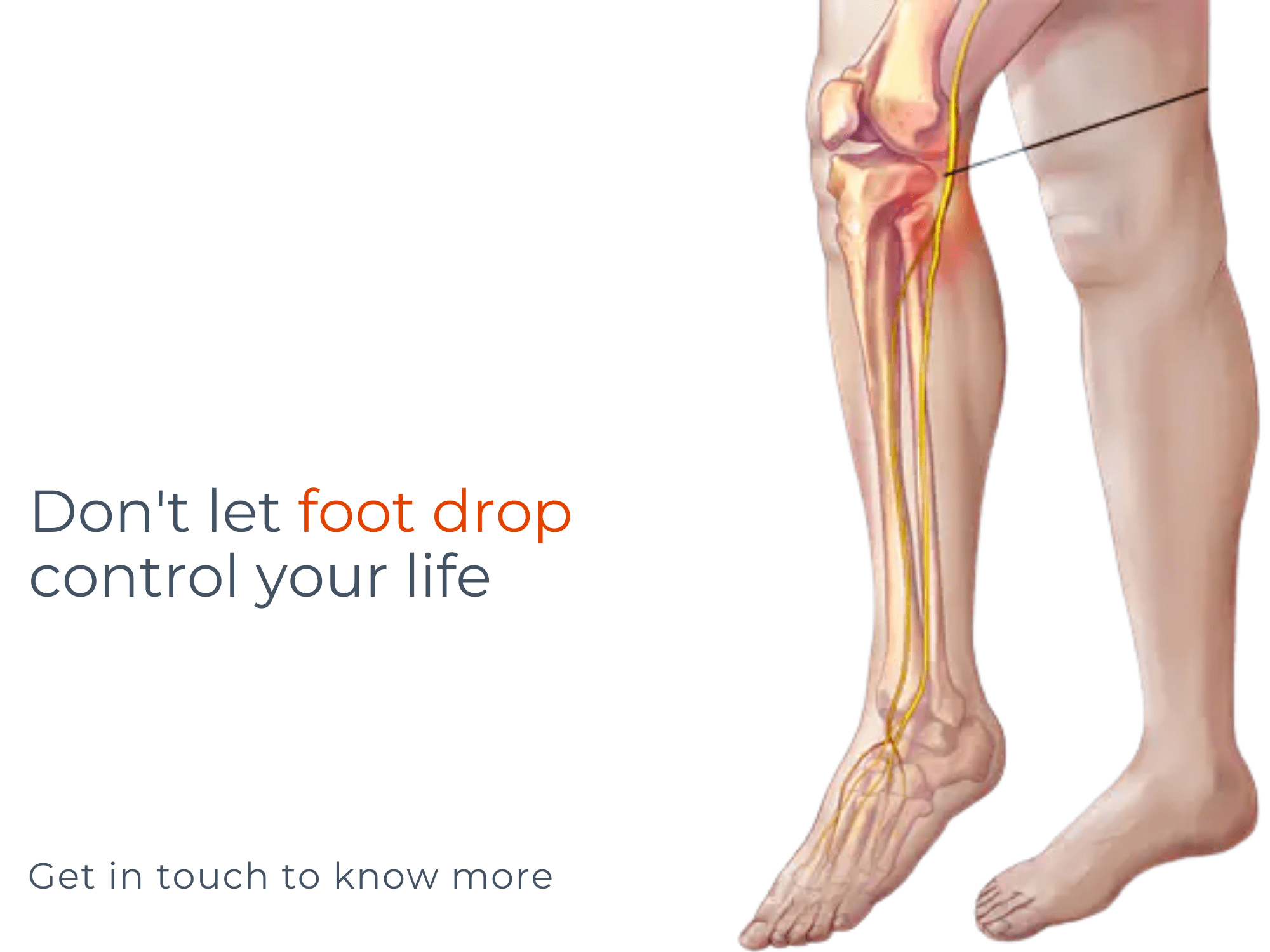 Foot Drop Treatment in Dubai