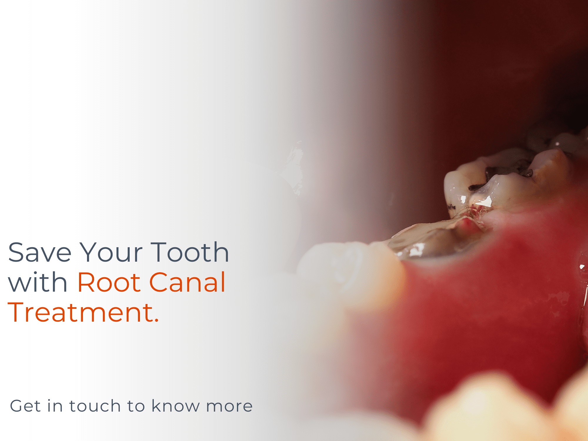 Root canal treatment cost dubai Root canal treatment cost Root canal treatment steps