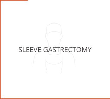 Sleeve Gastrectomy