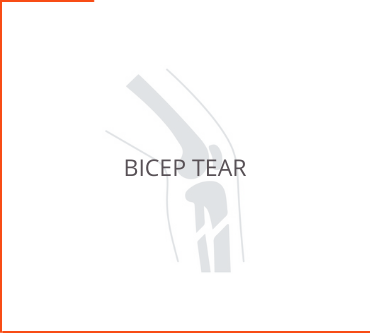 Bicep Tear