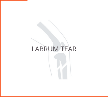 Labrum Tear