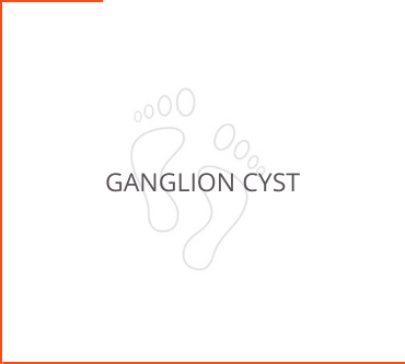 Ganglion Cyst